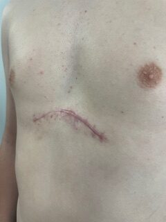 Resultado o planificación del abordaje del tórax